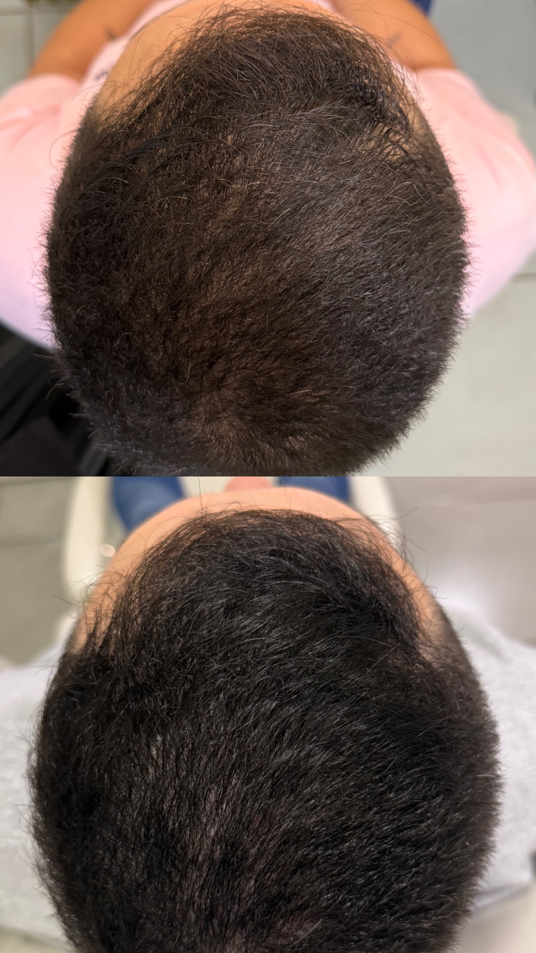 Evolução do tratamento capilar do paciente Klawller Nunes